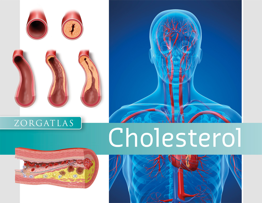 Zorgatlas Cholesterol - Cover